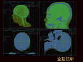 全脳照射の計画