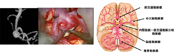 瘤 脳 手術 動脈 動脈瘤｜対象疾患と治療｜脳神経機能外科｜東京医科歯科大学