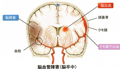 下 出血 原因 くも膜